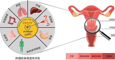 全癌標志物可以將宮頸癌的篩查提前到高級別瘤變階段